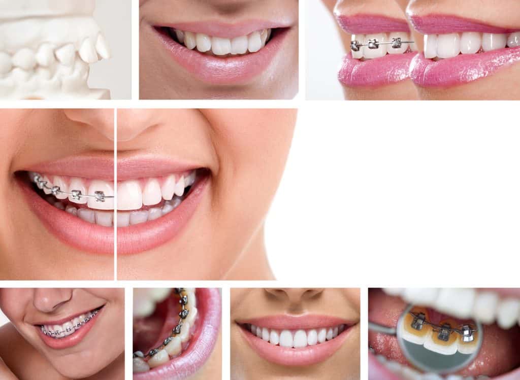 Braces Davie Florida